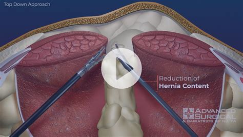 hernia incisional